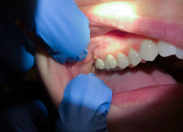 Emergency Dental Filling Replacement in CA